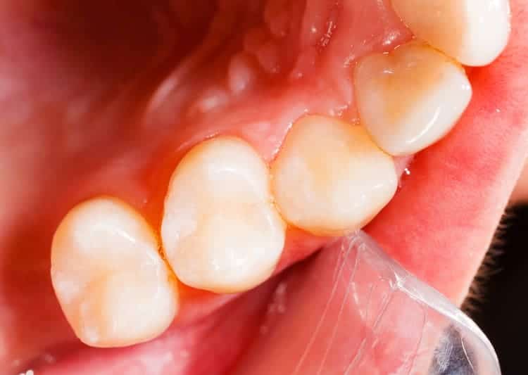 The mouth of a person with cavities after going through cavity filling treatment