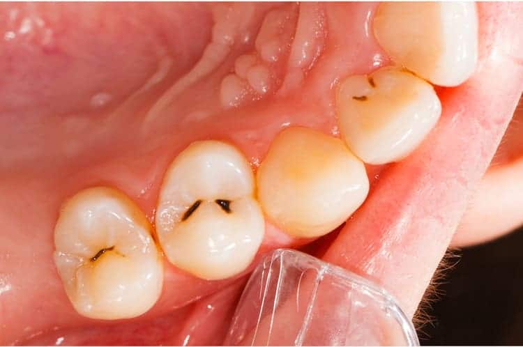 The mouth of a person with cavities before going through cavity filling treatment