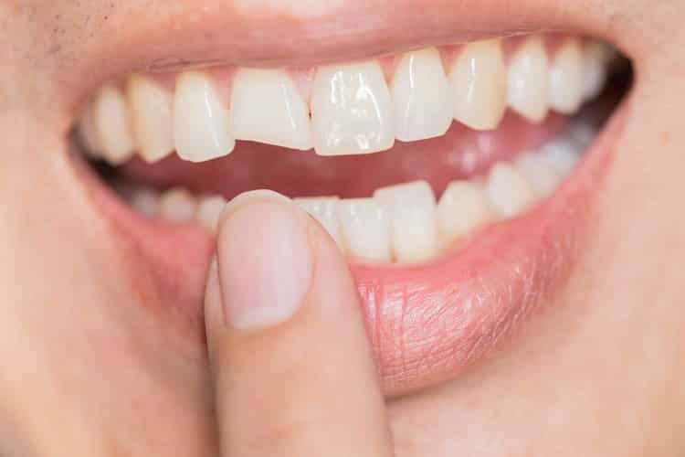 A person pointing at her chipped front tooth with her index finger