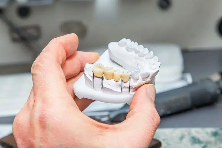 A person's hand holding a clay model of a dental bridge