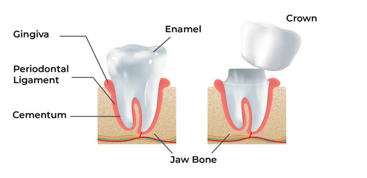 An illustration of a dental crown placement and labels of other parts of the tooth