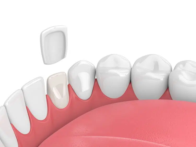 An illustration of a dental veneer being placed on a tooth