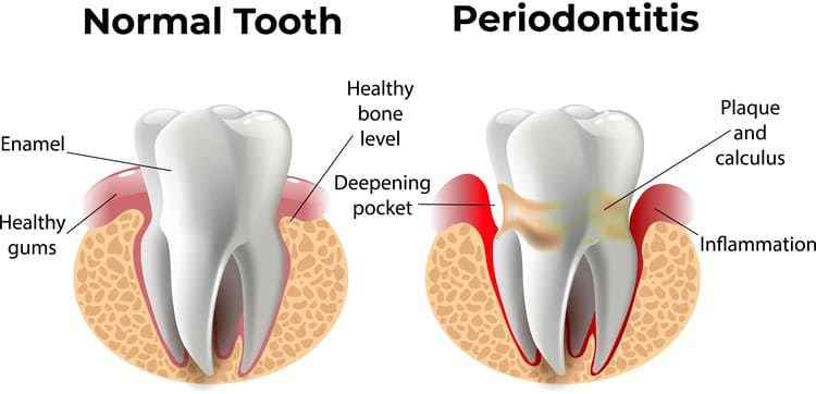 Illustration of the comparison between a healthy tooth and a tooth with gum disease