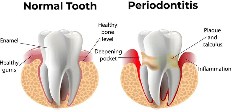 Illustration of the comparison between a healthy tooth and a tooth with gum disease