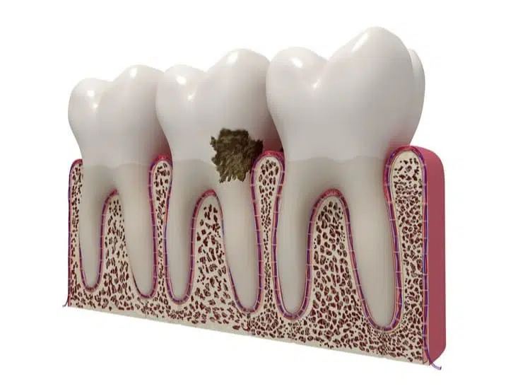 An illustration of gum disease on a tooth