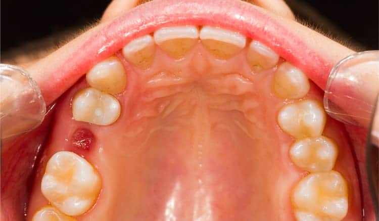 The teeth of a person after a tooth extraction is performed