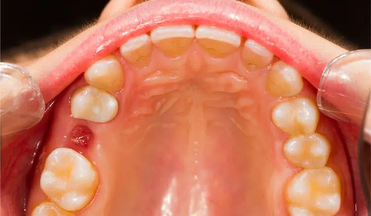 The teeth of a person after a tooth extraction is performed