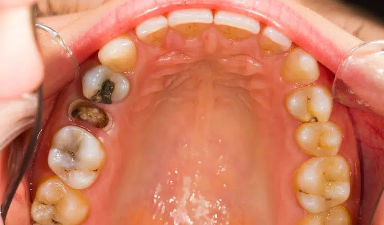 The teeth of a person before a tooth extraction is performed because it has cavitites