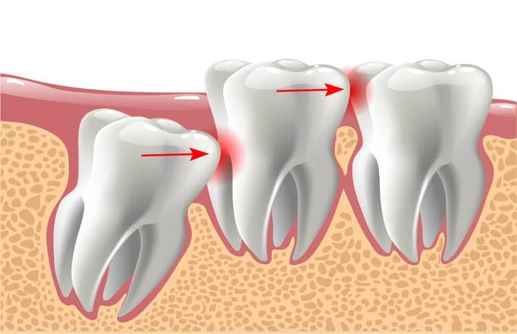 An illustration of wisdom teeth pushing against other teeth
