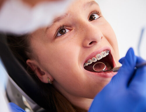 A Complete Guide to Braces: All Your Questions Answered!