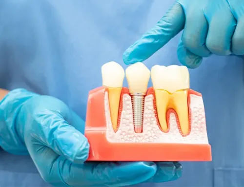 How Long Can a Root Canal Last Without a Crown – 4 Things to Expect