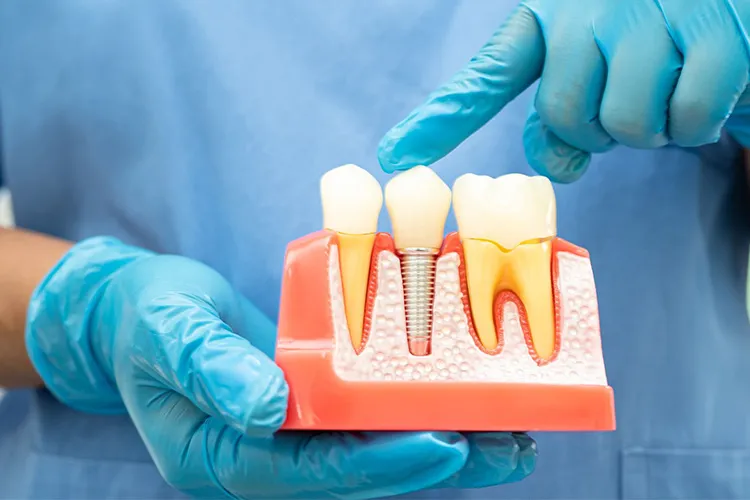 How Long Can a Root Canal Last Without a Crown
