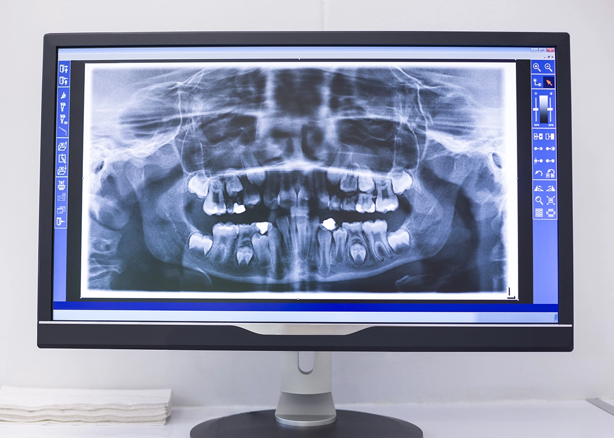 3D Teeth x-ray as part of general dentistry in Tampa, FL