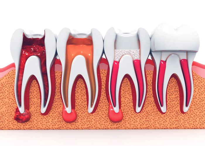 Root canal as part of general dentistry in Tampa, FL