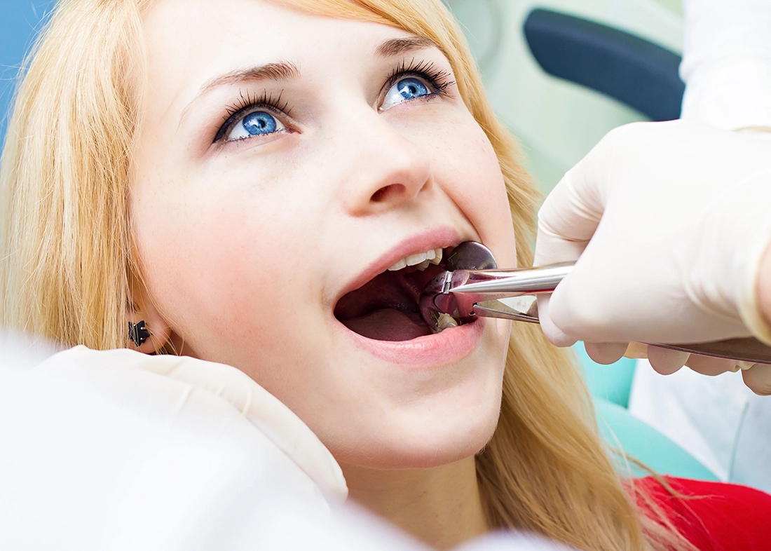 Wisdom teeth removal as part of general dentistry in Tampa, FL