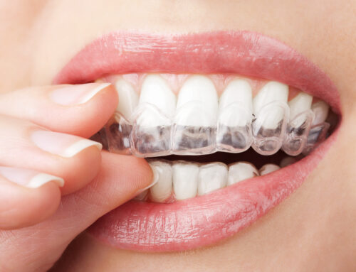 Discover the Magic of Invisalign: Your Path to a New Smile