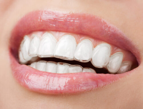 Transform Your Smile with Invisalign: A Tampa Guide