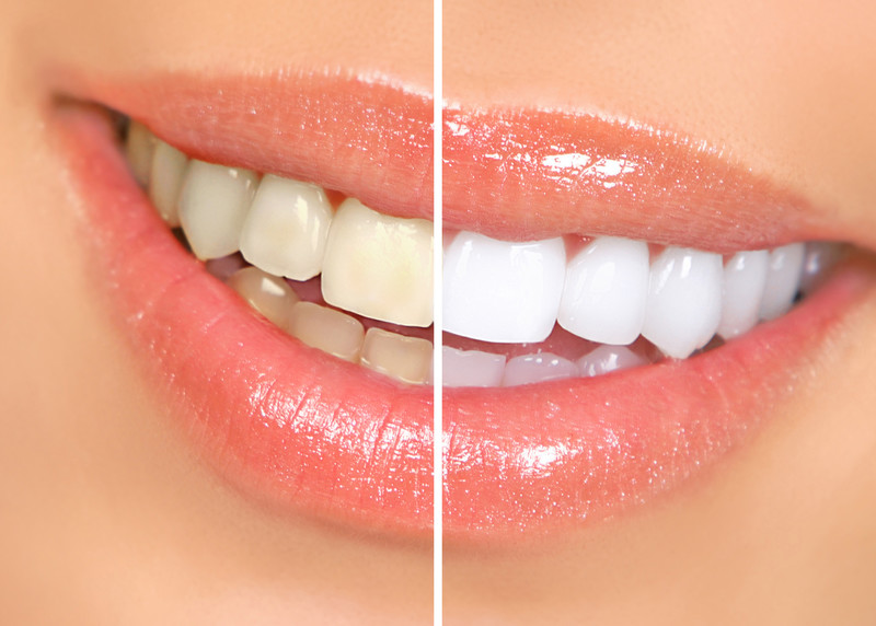 Before and after comparison of a patient’s teeth showing the results of professional teeth whitening at Tampa Palms Dentistry