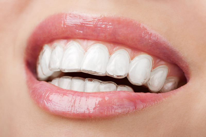 Close-up of a patient’s mouth wearing Invisalign® clear aligner, demonstrating discreet teeth straightening at Tampa Palms Dentistry