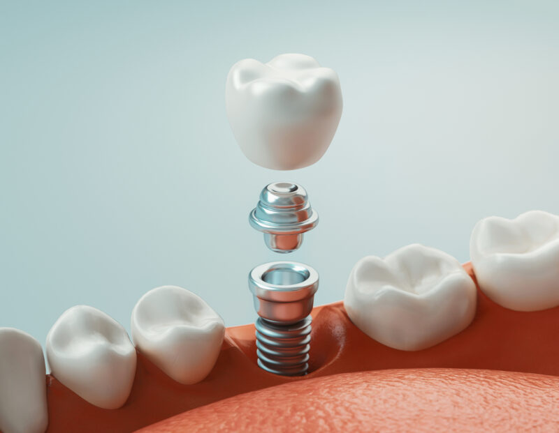 Dental care, dental implant, 3d rendering Close-up of a single tooth dental implant model, illustrating the titanium post and custom crown used at Tampa Palms Dentistry