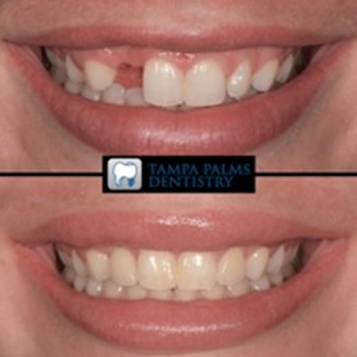 Cosmetic-crowns-veneers-smile-enhancement-tampa-palms-fl-before-after Before and after dental crowns and veneers in Tampa Palms, FL