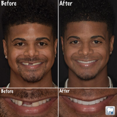 Crown-veneer-restoration-after-dental-trauma-tampa-palms-fl-before-after Before and after crowns and veneers restoring teeth lost from dental trauma in Tampa Palms, FL