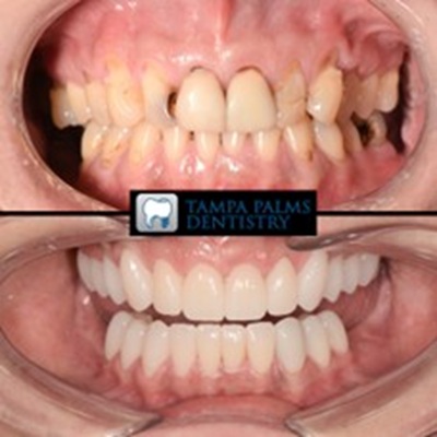 ceramic-crowns-worn-decayed-teeth-restoration-tampa-palms-fl-before-after Before and after ceramic crowns restoring worn and decayed teeth in Tampa Palms, FL