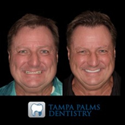 cosmetic-dentistry-tampa-palms-full-smile-restoration-worn-teeth-before-after Cosmetic Dentistry in Tampa Palms – Full Smile Restoration for Worn and Shortened Teeth