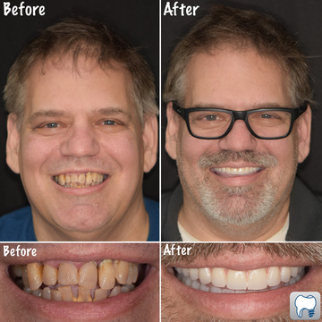 full-mouth-dental-implants-tampa-palms-severe-gum-disease-before-after Full Mouth Dental Implants in Tampa Palms