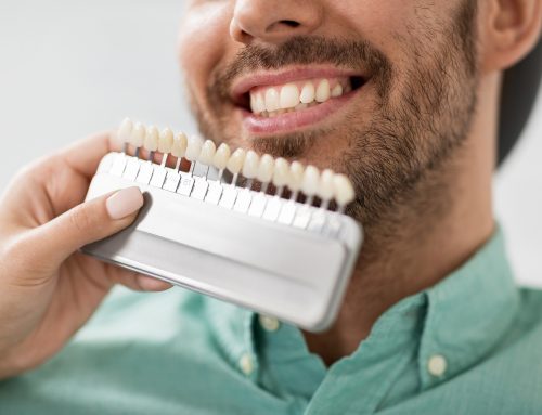 How Long Do Veneers Last? Care & Maintenance Tips