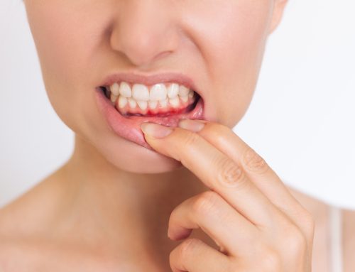 Dental Bonding vs. Veneers: Which Is Better for Fixing Chipped or Uneven Teeth?